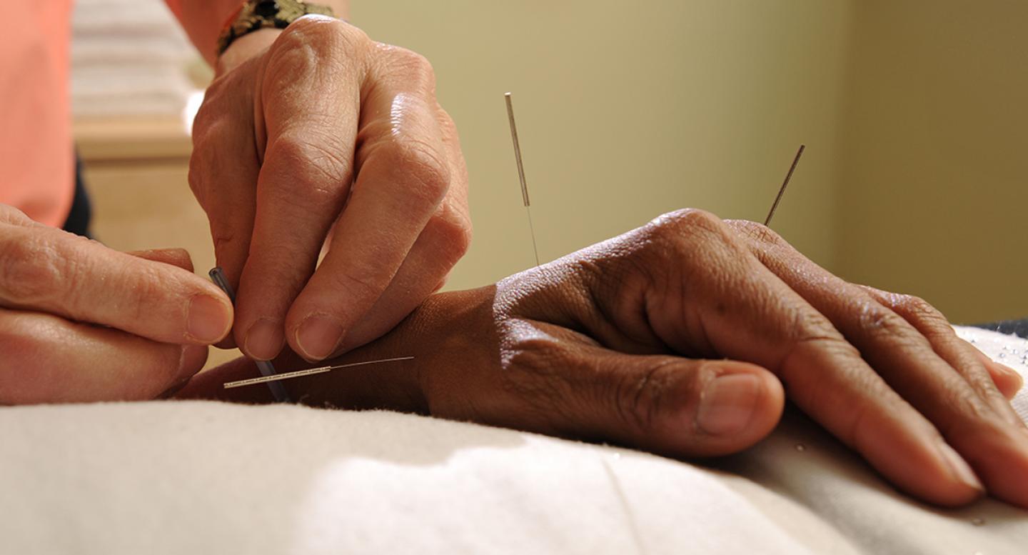 An acupuncturists needles a patient's hand