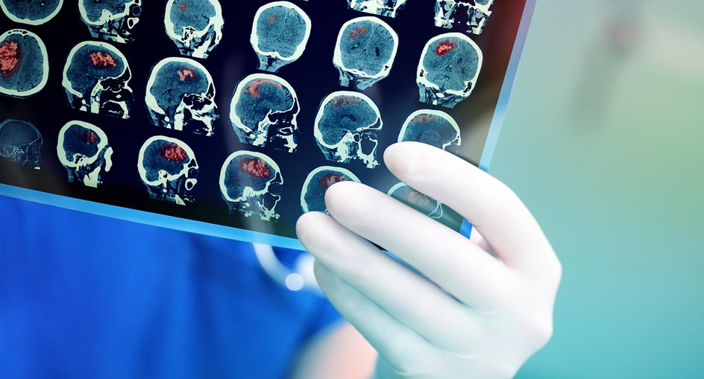 A doctor holds a film of brain images related to a stroke
