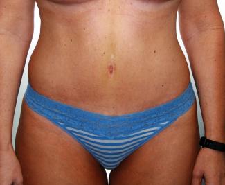 2 months post mommy front (2).jpg