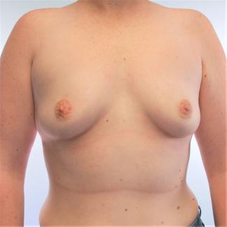 New,KR,breastaug,front,preop.jpg