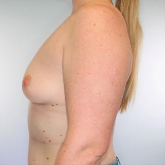 New,KR,breastaug,lateral,preop.jpg