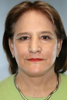 facelift post front perioral dermabrasion.JPG