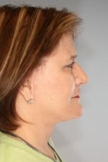 facelift post side dermabrasion.JPG