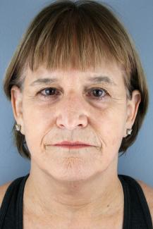 facelift pre front.JPG