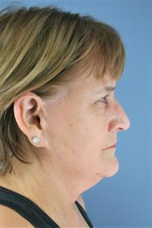 facelift pre side.JPG