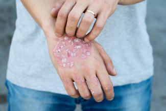 A man scratches psoriasis on his hand
