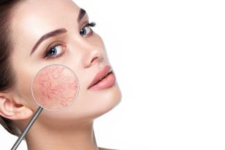 A woman holds a magnifying glass up to the rosacea on her face